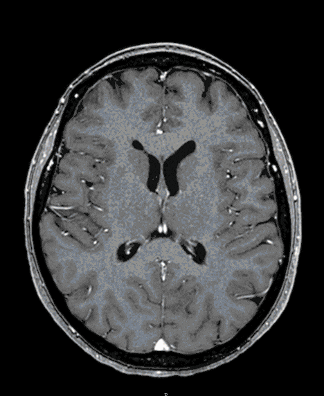 University Clinic for Neurosurgery - Skull Base Meningioma